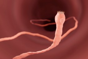 Human Case of Flesh-Eating Parasites Reported in US