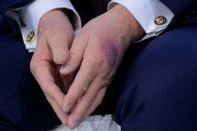 Donald Trump Hand Bruise Davos Excuse Explained Table